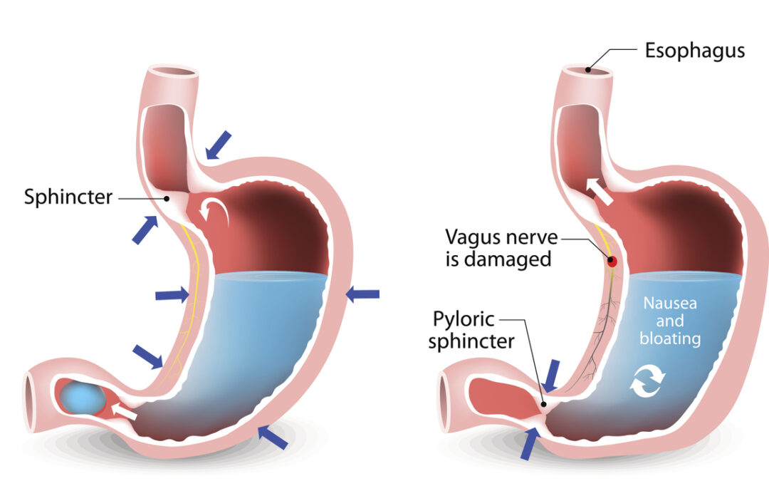 Gastroparesis Lawsuit